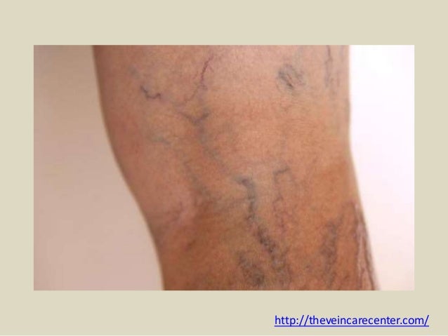 Varicose veins dissertation 06 image