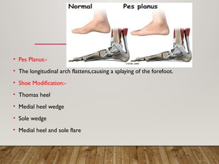 Various Types OF Shoe Modification in orthotics | PPTX