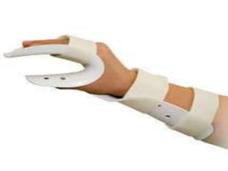 Splints Displayu Various types of splints and basics | PPTX