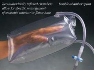 Biology Splints Various types of splints and basics | PPTX