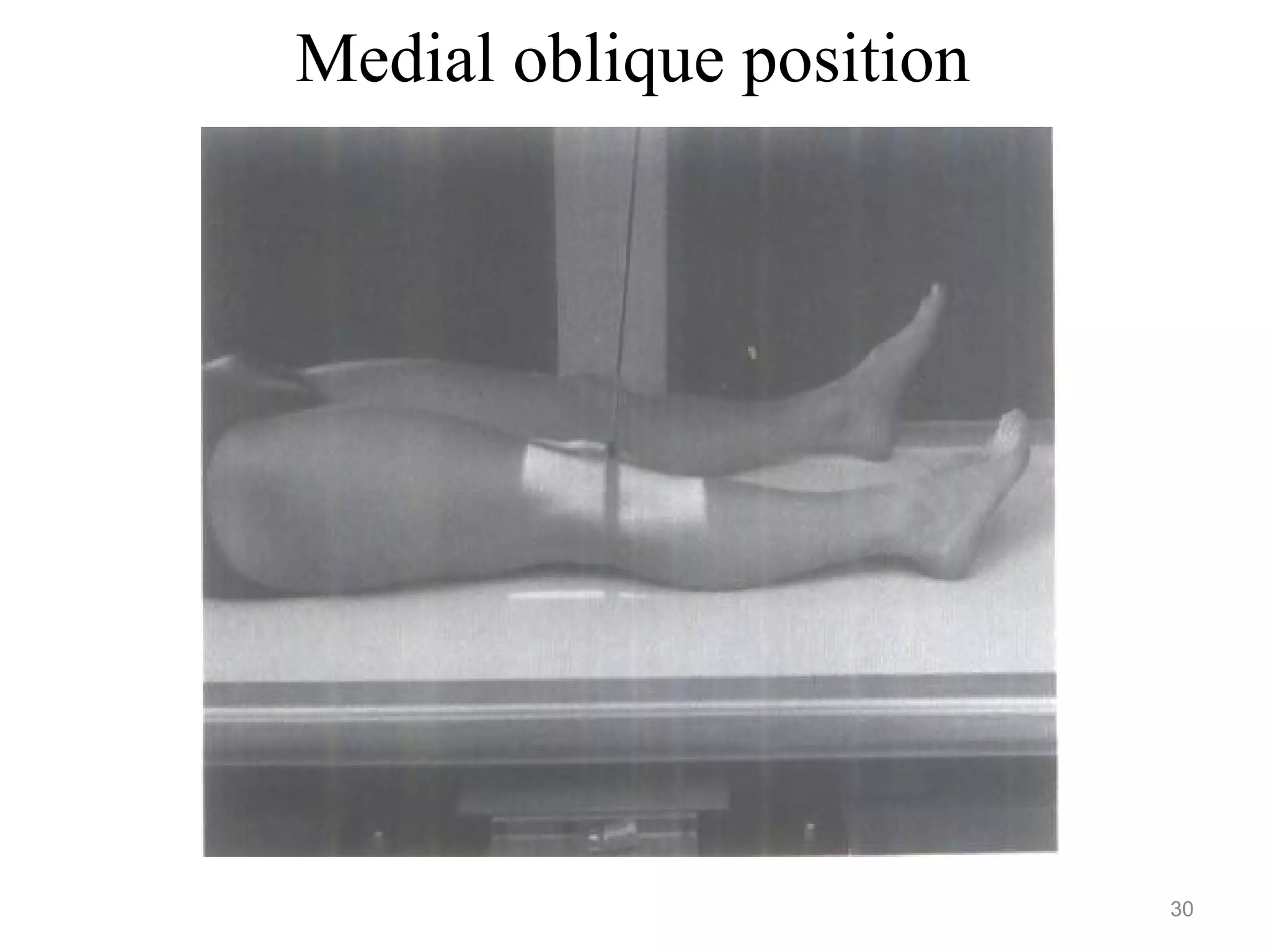 Medial oblique position
30
 