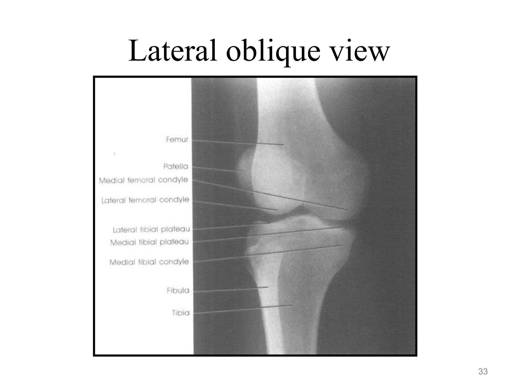 Lateral oblique view
33
 