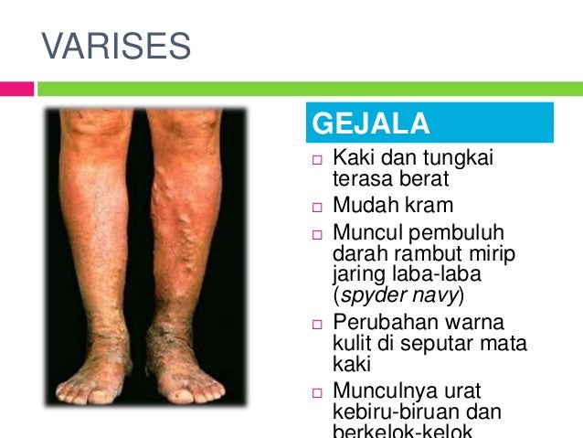 Hasil gambar untuk Varises