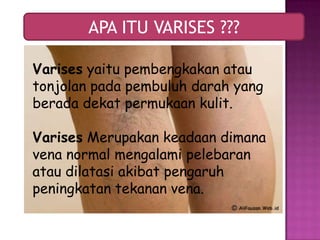 Varises pada ibu hamil slide | PPTX