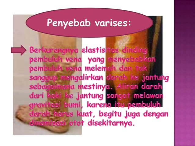 Varises pada ibu hamil slide | PPTX