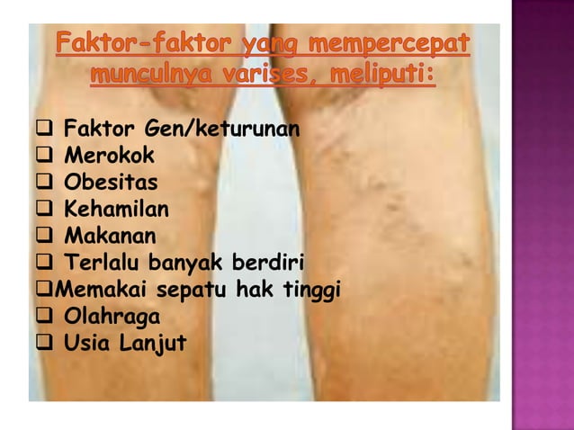 Varises pada ibu hamil slide | PPTX