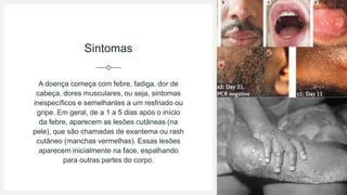 Sintomas
A doença começa com febre, fadiga, dor de
cabeça, dores musculares, ou seja, sintomas
inespecíficos e semelhantes a um resfriado ou
gripe. Em geral, de a 1 a 5 dias após o início
da febre, aparecem as lesões cutâneas (na
pele), que são chamadas de exantema ou rash
cutâneo (manchas vermelhas). Essas lesões
aparecem inicialmente na face, espalhando
para outras partes do corpo.
 