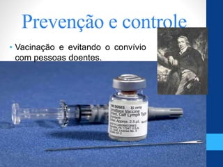 Prevenção e controle
• Vacinação e evitando o convívio
com pessoas doentes.
 