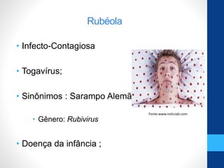 Rubéola
• Infecto-Contagiosa
• Togavírus;
• Sinônimos : Sarampo Alemão
• Gênero: Rubivirus
• Doença da infância ;
Fonte:www.noticiaki.com
 