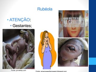 Rubéola
• ATENÇÂO:
• Gestantes;
Fonte: jornalesp.com
Fonte: jornalesp.com
Fonte: amamosaenfermagem.blogspot.com
 