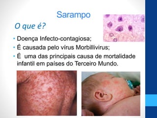 Sarampo
• Doença Infecto-contagiosa;
• É causada pelo vírus Morbillivirus;
• É uma das principais causa de mortalidade
infantil em países do Terceiro Mundo.
O que é?
 