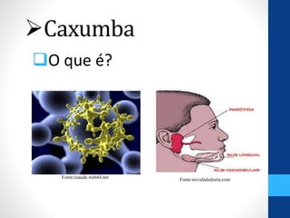 Caxumba
O que é?
Fonte:esaude.web44.net Fonte:novidadediaria.com
 