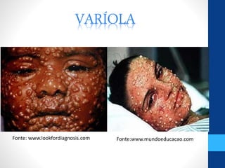 VARÍOLA
Fonte: www.lookfordiagnosis.com Fonte:www.mundoeducacao.com
 