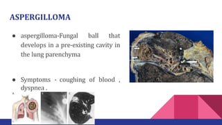 ASPERGILLOMA
● aspergilloma-Fungal ball that
develops in a pre-existing cavity in
the lung parenchyma
● Symptoms - coughing of blood ,
dyspnea .
 