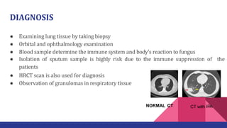 DIAGNOSIS
● Examining lung tissue by taking biopsy
● Orbital and ophthalmology examination
● Blood sample determine the immune system and body’s reaction to fungus
● Isolation of sputum sample is highly risk due to the immune suppression of the
patients
● HRCT scan is also used for diagnosis
● Observation of granulomas in respiratory tissue
NORMAL CT CT with IPA
 