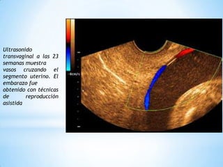 Ultrasonido transvaginal a las 23 semanas muestravasos cruzando el segmento uterino. El embarazo fueobtenido con técnicas de reproducción asistida