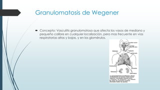 Granulomatosis de Wegener
 Concepto: Vasculitis granulomatosa que afecta los vasos de mediano y
pequeño calibre en cualquier localización, pero mas frecuente en vias
respiratorias altas y bajas, y en los glomérulos.
 