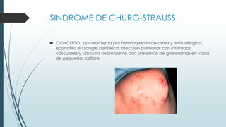 SINDROME DE CHURG-STRAUSS
 CONCEPTO: Se caracteriza por historia previa de asma y rinitis alérgica,
eosinofilia en sangre periférica, afección pulmonar con infiltrados
vasculares y vasculitis necrotizante con presencia de granulomas en vasos
de pequeños calibre.
 