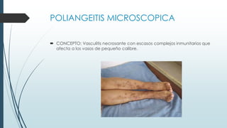 POLIANGEITIS MICROSCOPICA
 CONCEPTO: Vasculitis necrosante con escasos complejos inmunitarios que
afecta a los vasos de pequeño calibre.
 