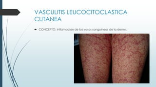 VASCULITIS LEUCOCITOCLASTICA
CUTANEA
 CONCEPTO: Inflamación de los vasos sanguíneos de la dermis.
 