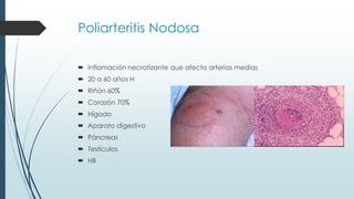 Poliarteritis Nodosa
 Inflamación necrotizante que afecta arterias medias
 20 a 60 años H
 Riñón 60%
 Corazón 70%
 Hígado
 Aparato digestivo
 Páncreas
 Testículos
 HB
 