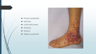  Purpura palpable
 Urticaria
 Lívido reticulares
 Nódulos
 Ulceras
 Flebitis superficial
 