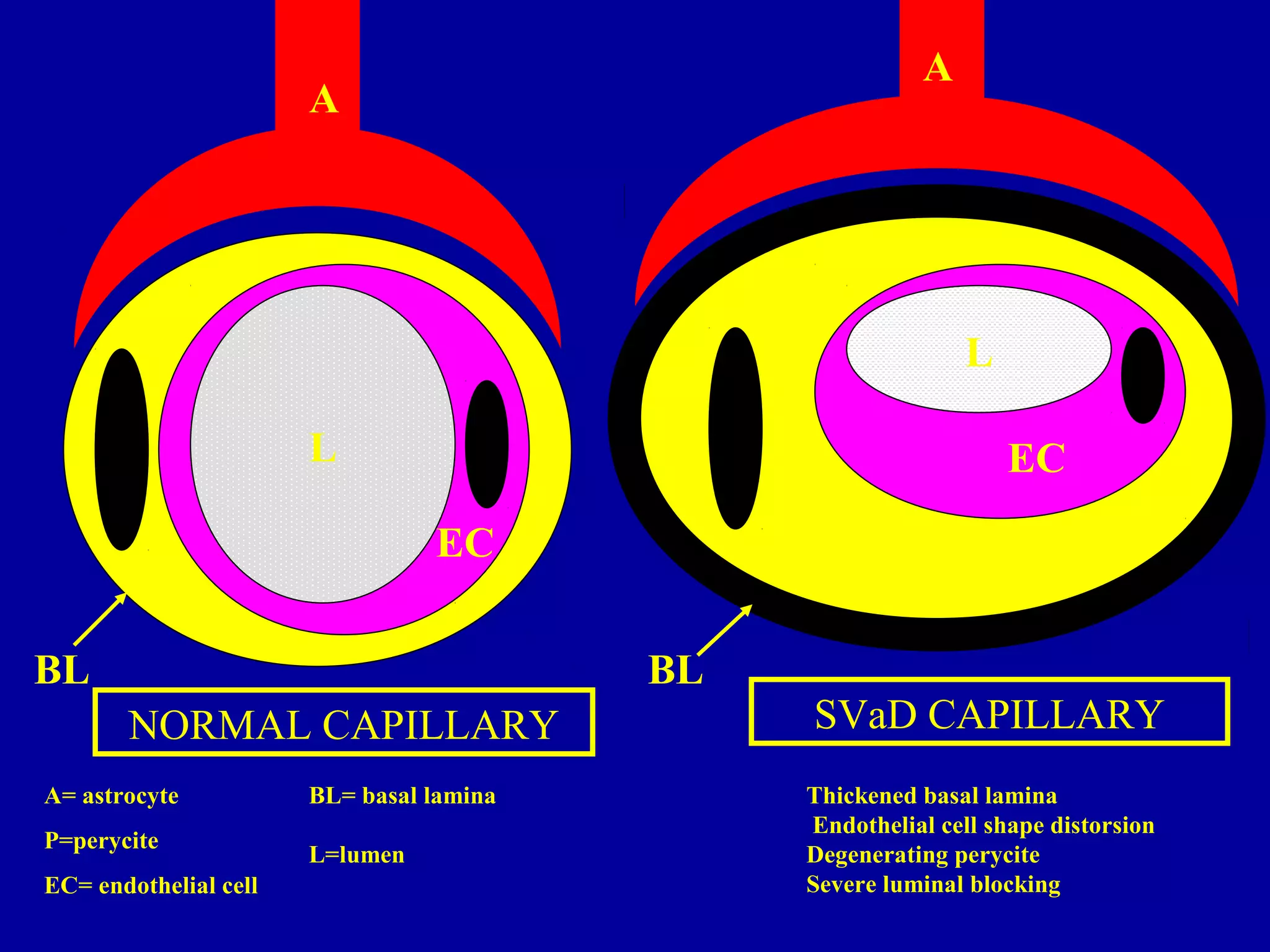 A
P
EC
NORMAL CAPILLARY
A
P
EC
SVaD CAPILLARY
BL BL
L
L
A= astrocyte
P=perycite
EC= endothelial cell
BL= basal lamina
L=lumen
Thickened basal lamina
Endothelial cell shape distorsion
Degenerating perycite
Severe luminal blocking
 