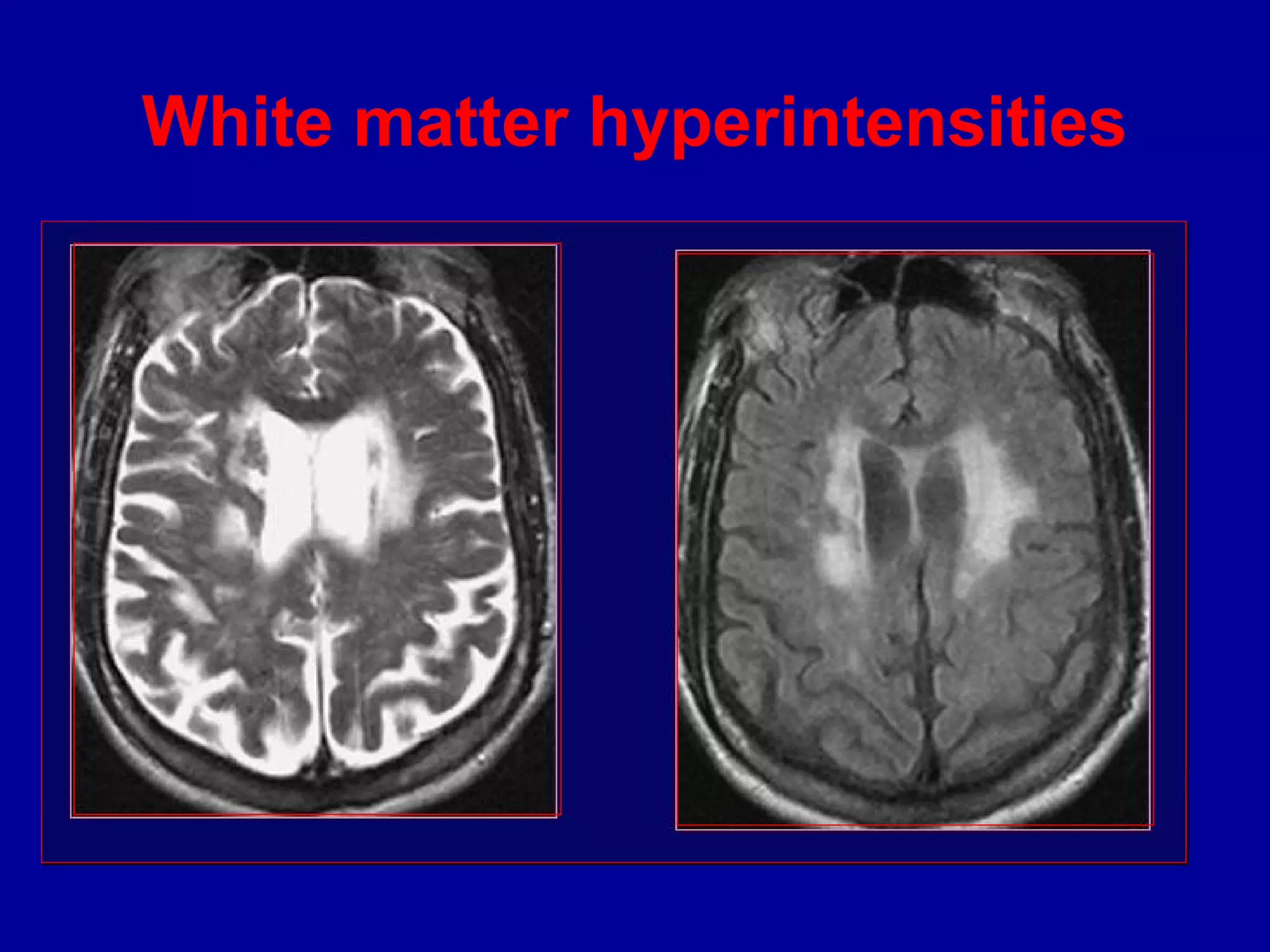 White matter hyperintensities
 