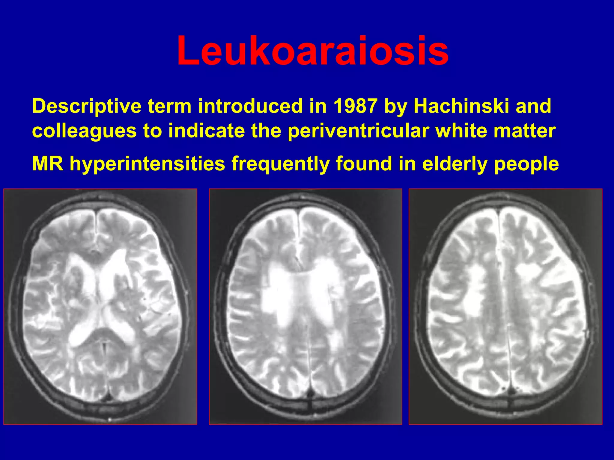 Descriptive term introduced in 1987 by Hachinski and
colleagues to indicate the periventricular white matter
MR hyperintensities frequently found in elderly people
Leukoaraiosis
 