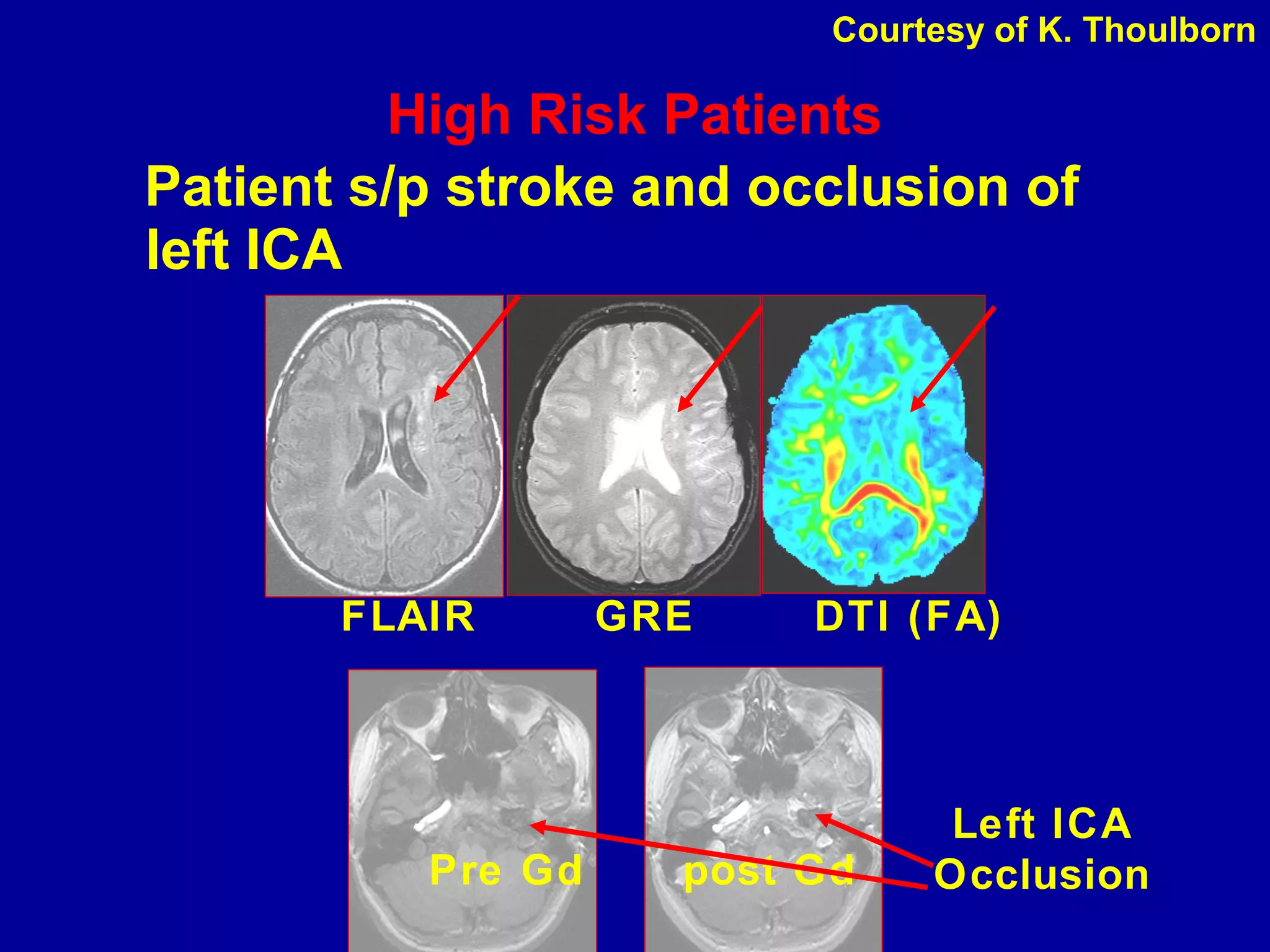 High Risk Patients
Patient s/p stroke and occlusion of
left ICA
Pre Gd post Gd
FLAIR GRE DTI (FA)
Left ICA
Occlusion
Courtesy of K. Thoulborn
 