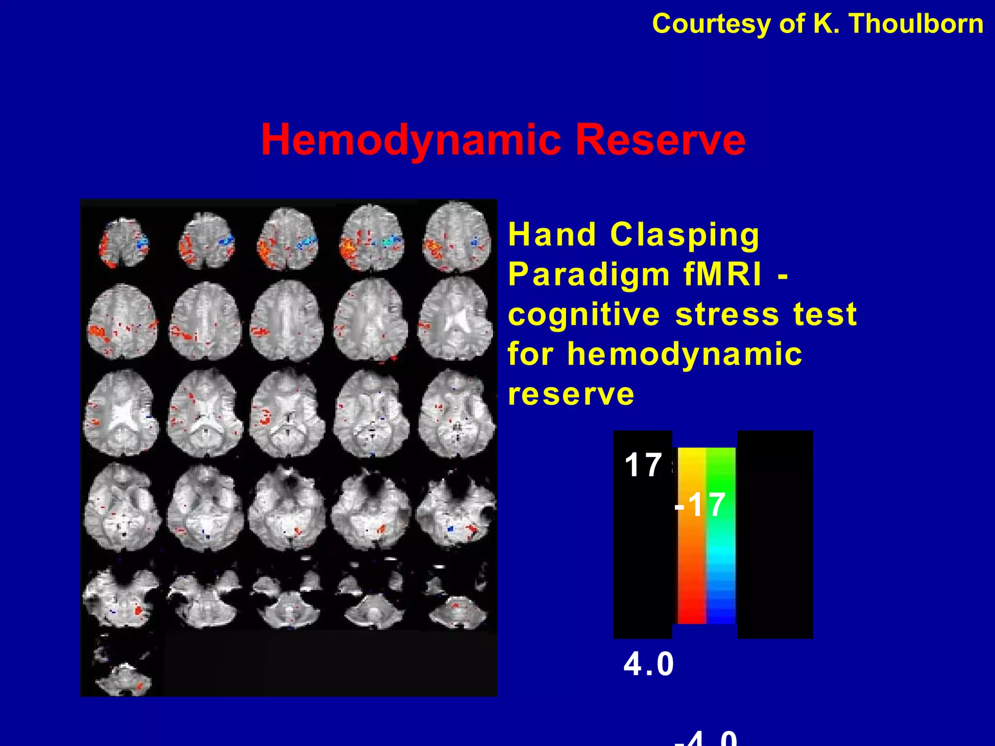 Hemodynamic Reserve
Hand Clasping
Paradigm fMRI -
cognitive stress test
for hemodynamic
reserve
17
-17
4.0
Courtesy of K. Thoulborn
 