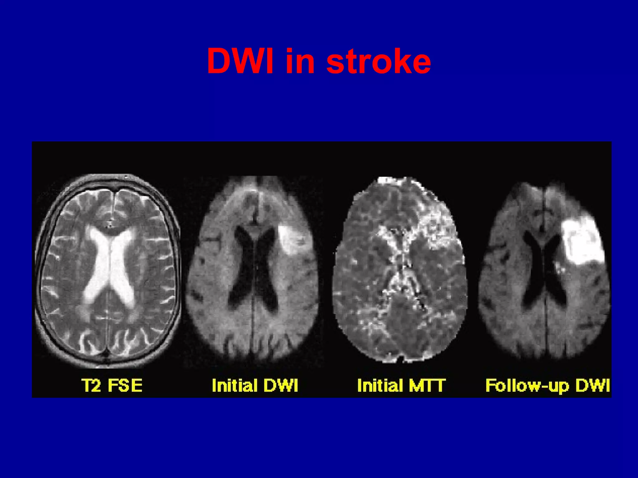 DWI in stroke
 