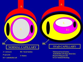 A
P
EC
NORMAL CAPILLARY
A
P
EC
SVaD CAPILLARY
BL BL
L
L
A= astrocyte
P=perycite
EC= endothelial cell
BL= basal lamina
L=lumen
Thickened basal lamina
Endothelial cell shape distorsion
Degenerating perycite
Severe luminal blocking
 