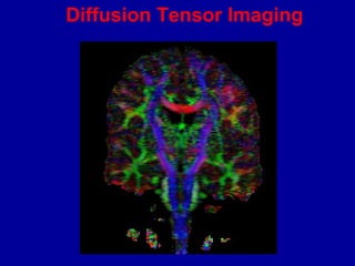 Diffusion Tensor Imaging
 