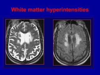 White matter hyperintensities
 