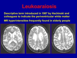 Descriptive term introduced in 1987 by Hachinski and
colleagues to indicate the periventricular white matter
MR hyperintensities frequently found in elderly people
Leukoaraiosis
 