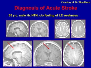 Diagnosis of Acute Stroke
65 y.o. male Hx HTN, c/o feeling of LE weakness
Courtesy of K. Thoulborn
 