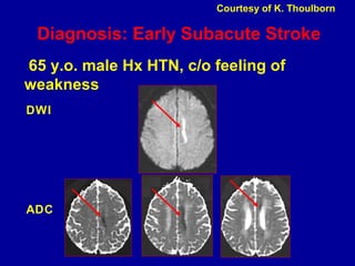 Diagnosis: Early Subacute Stroke
65 y.o. male Hx HTN, c/o feeling of
weakness
DWI
ADC
Courtesy of K. Thoulborn
 