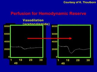 Perfusion for Hemodynamic Reserve
1 10 20 30
40
8000
6000
4000
2000
0
Vasodilation
(acetozolamide)
1 10 20 30
40
8000
6000
4000
2000
0
Courtesy of K. Thoulborn
 