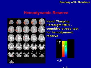 Hemodynamic Reserve
Hand Clasping
Paradigm fMRI -
cognitive stress test
for hemodynamic
reserve
17
-17
4.0
Courtesy of K. Thoulborn
 