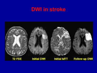 DWI in stroke
 