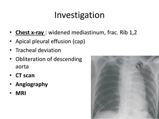 Investigation
•
•
•
•

Chest x-ray : widened mediastinum, frac. Rib 1,2
Apical pleural effusion (cap)
Tracheal deviation
Obliteration of descending
aorta
• CT scan
• Angiography
• MRI

 