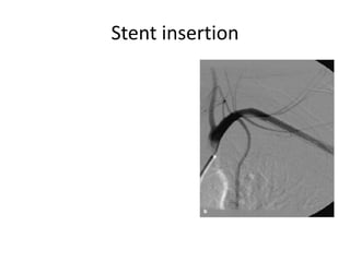 Stent insertion

 