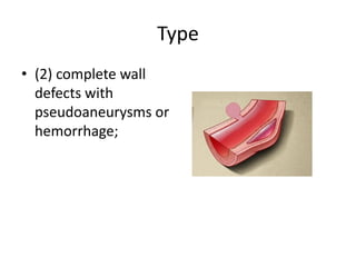 Type
• (2) complete wall
defects with
pseudoaneurysms or
hemorrhage;

 