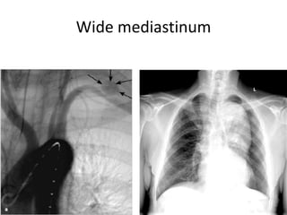 Wide mediastinum

 