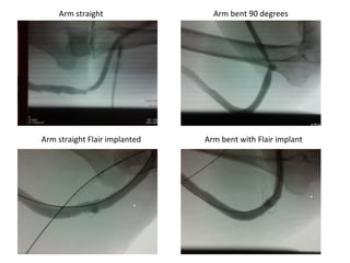 Arm straight Arm bent 90 degrees
Arm straight Flair implanted Arm bent with Flair implant
 