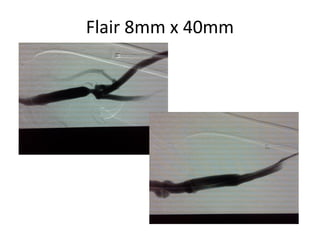 Flair 8mm x 40mm
 