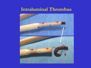 Intraluminal Thrombus
 
