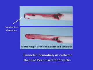 Intraluminal
thrombus
“Saran-wrap” layer of thin fibrin and thrombus
Tunneled hemodialysis catheter
that had been used for 6 weeks
 
