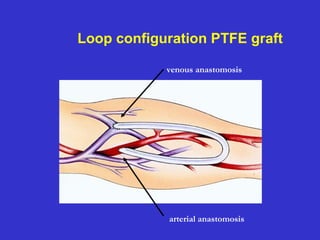 Loop configuration PTFE graft
venous anastomosis
arterial anastomosis
 